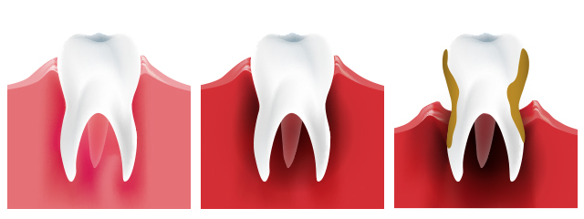 牙周病簡言之就是牙齒周圍組織受到細菌感染，持續惡化，造成牙縫變大，支撐牙齒的牙齦與齒槽骨萎縮，最終掉牙。